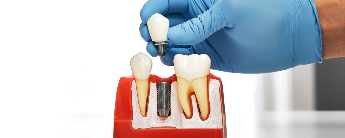 dental implant process timeline