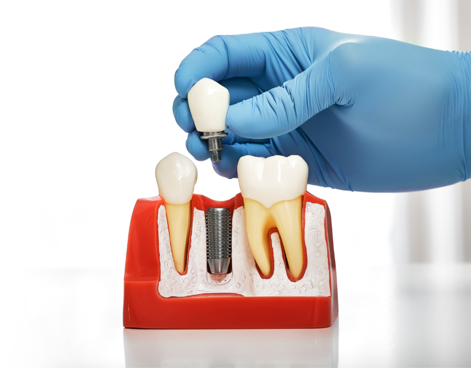 dental implant process timeline