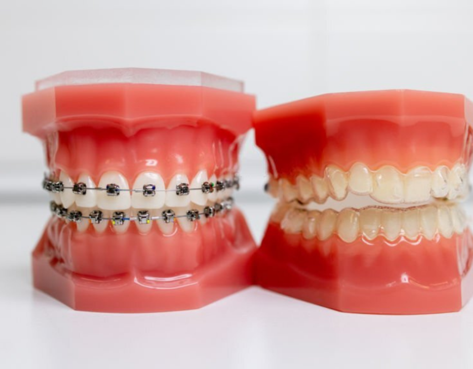 should I get braces or invisalign