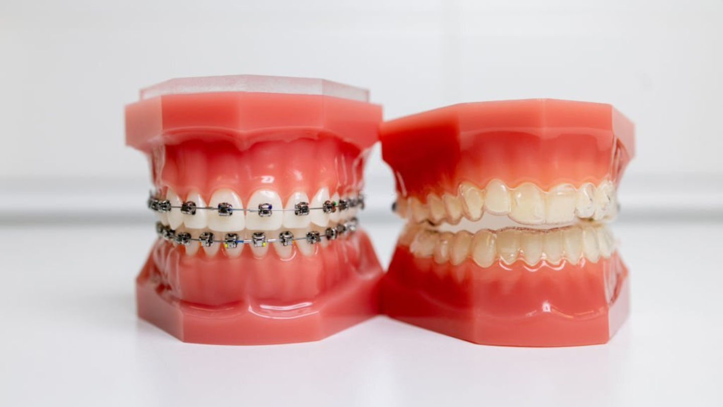 should I get braces or invisalign