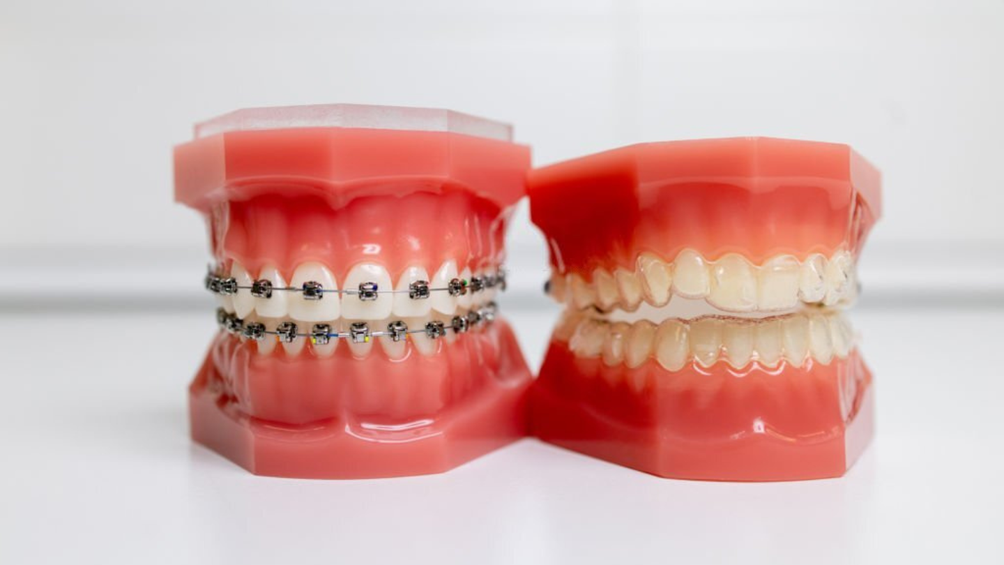 https://www.trailheadadvanceddentistry.com/wp-content/uploads/2023/03/should-I-get-braces-or-invisalign.png