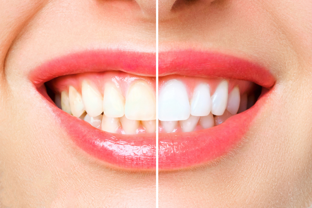 teeth-whitening-results-matthews