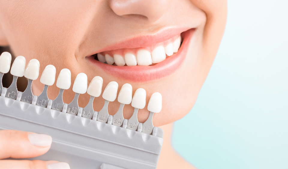 what are dental veneers and how do they work