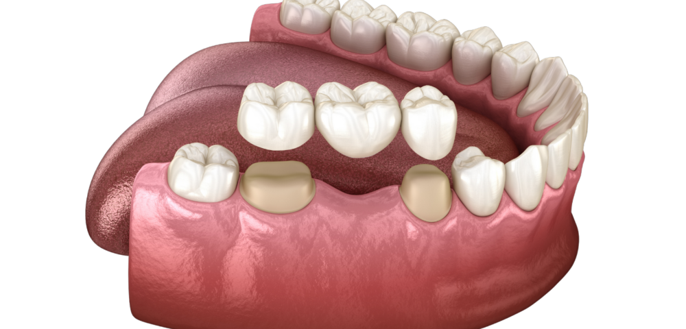 what is dental crown and bridge