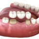 what is dental crown and bridge
