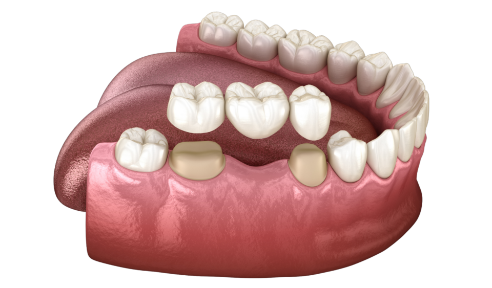 what is dental crown and bridge