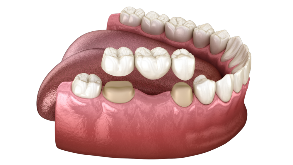 what is dental crown and bridge