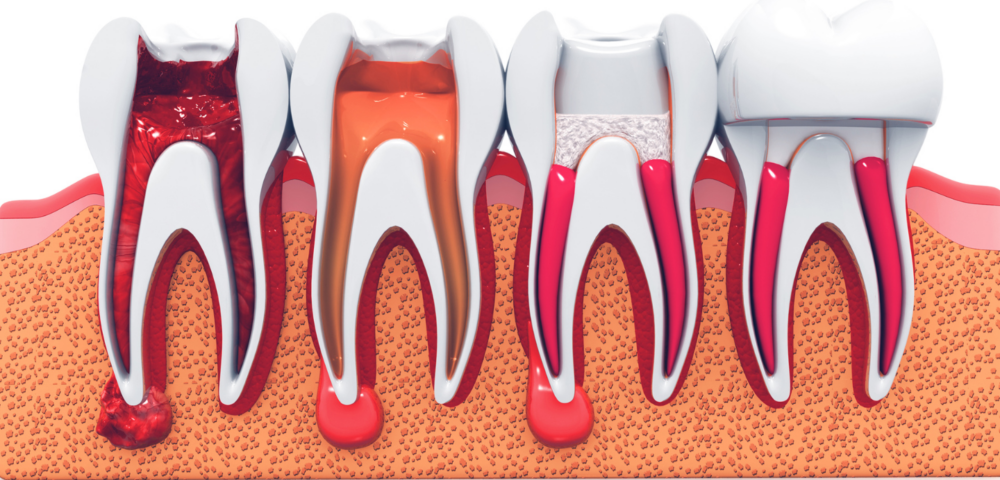 are root canals safe