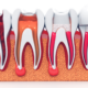 are root canals safe