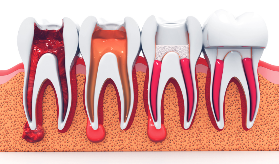 are root canals safe