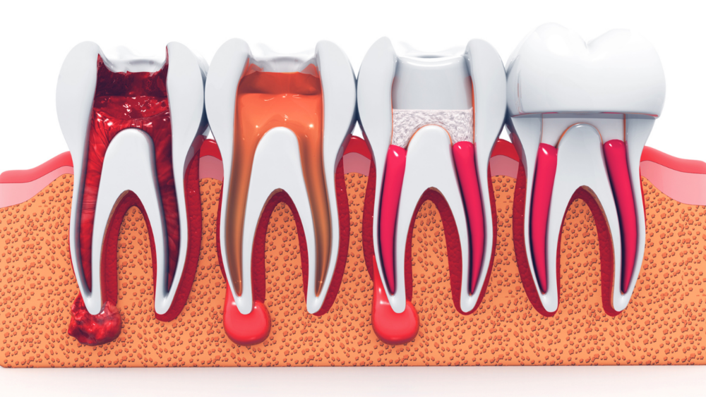 are root canals safe