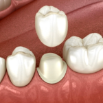 how long does a dental crown last