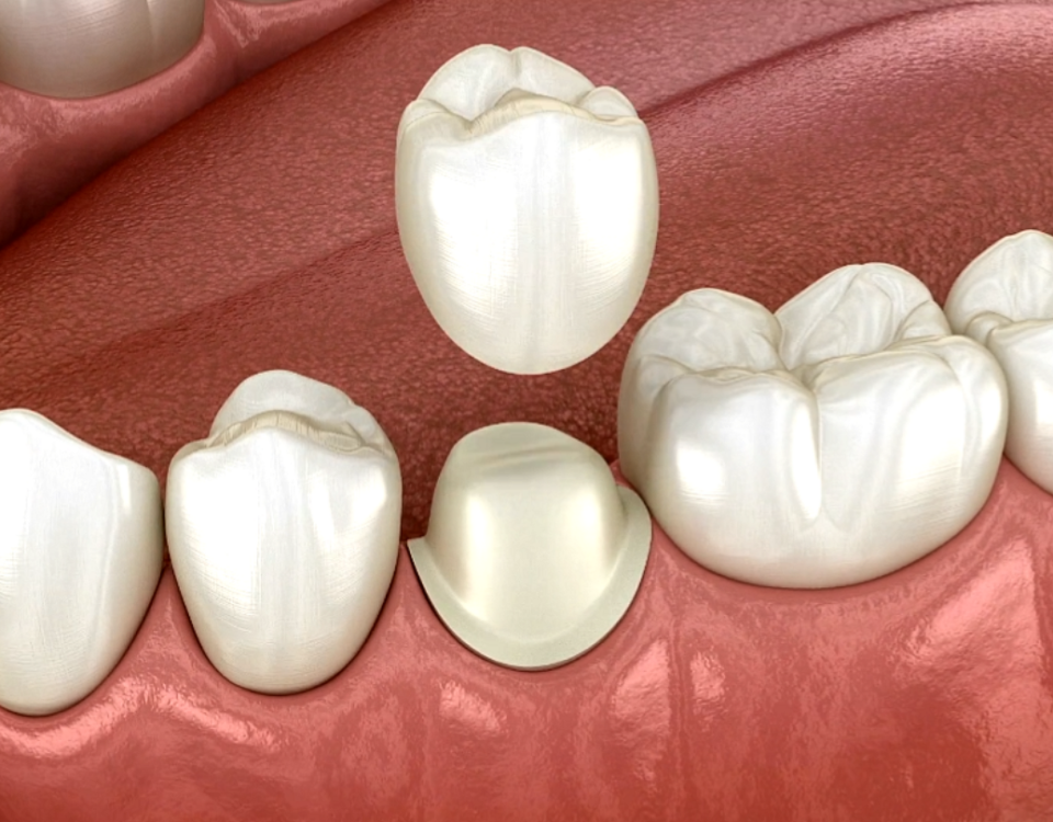 how long does a dental crown last