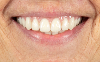 dentures-after-1