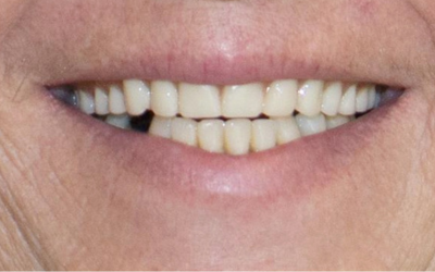 dentures-before-1