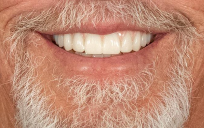 implants-after-2