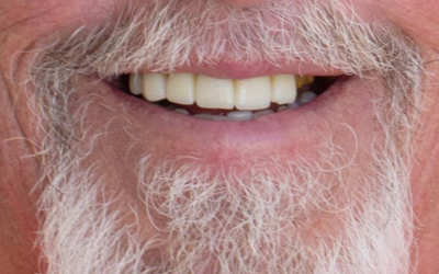 implants-before-1