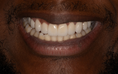 veneers-after-1