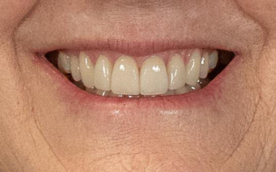 veneers-after-2