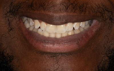 veneers-before-1