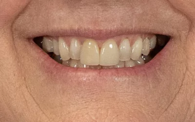 veneers-before-2