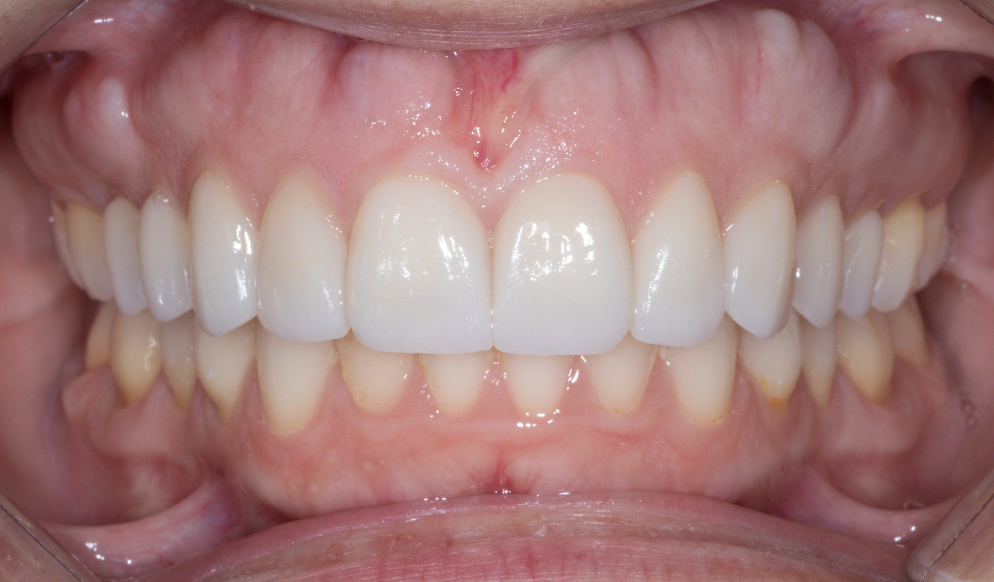 Veneers After