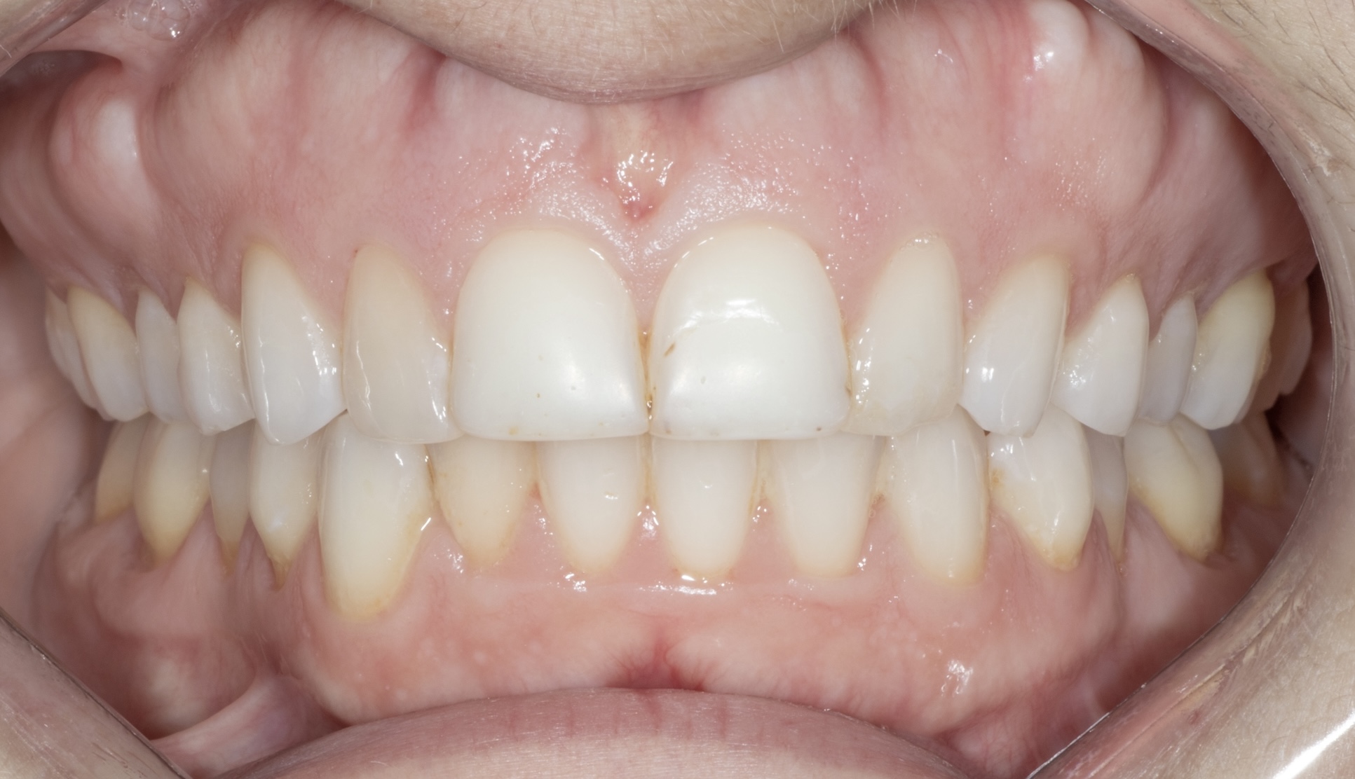 Veneers After