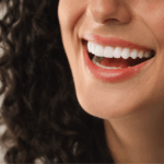 How Long Does It Take to Get Veneers?