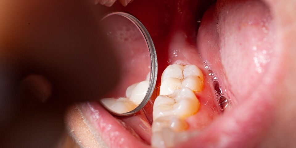 how to treat early signs of a cavity