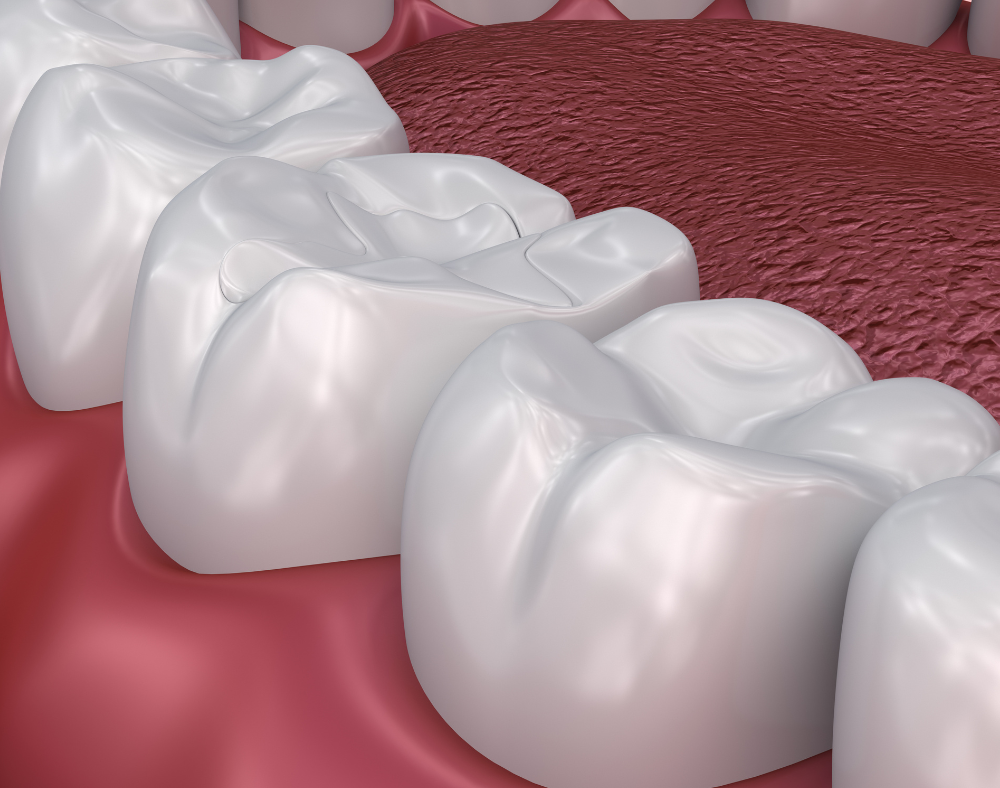 Tooth Fillings